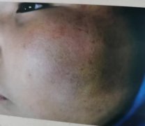 村民诉称其儿子被村干部带人殴打致创伤后应激障碍